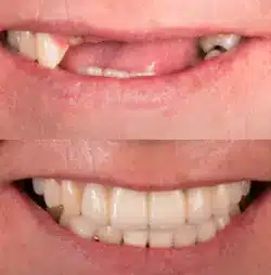 implante-3.webp